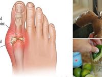 Actions To Take To Reduce Uric Acid And Prevent Gout