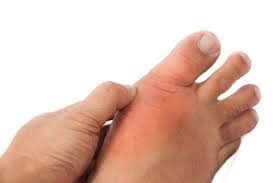 Simple Gout Remedies You Can Try Right Now