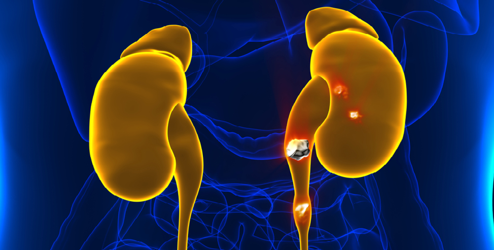 Kidney Stones, The Top 6 Things You Should Know About