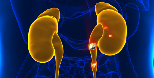 Kidney Stones, The Top 6 Things You Should Know About
