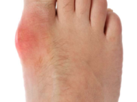 Everything You Need To Know About Gout!