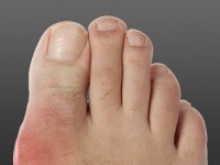 Natural Remedies for Gout