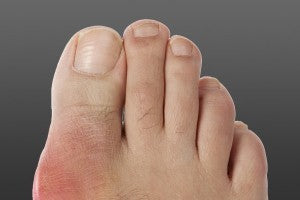 Common Myths about Gout