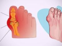 The 7 Foods That Will Make Gout Worse