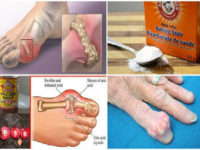 House Hold Products That Can Help With Gout
