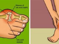 8 Ways to Reduce Uric Acid Crystals Naturally
