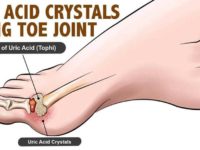 Do You Know These Ways To Deal With Gout?