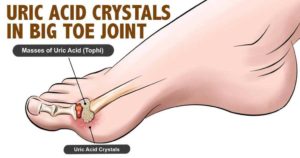 Causes of Gout