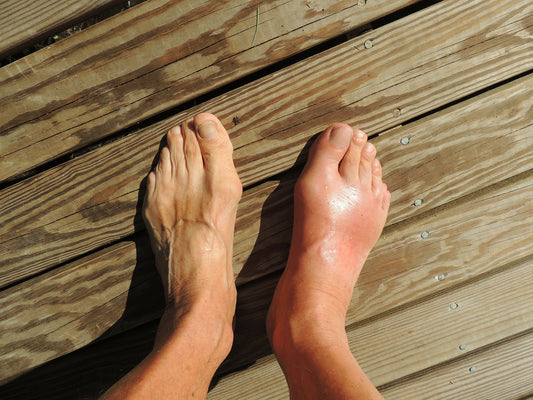Gout Triggers