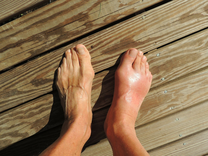 Gout Triggers
