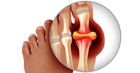 Foods to avoid if you suffer from gout