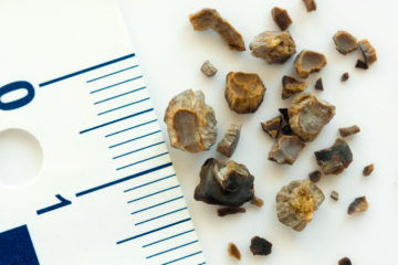 Kidney Stones: Should you be worried or not?